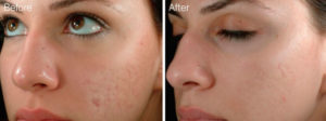 Microneedling Before and After Pictures Melbourne, FL