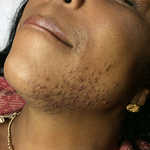 5 Facts About Laser Facial Hair Removal Treatments