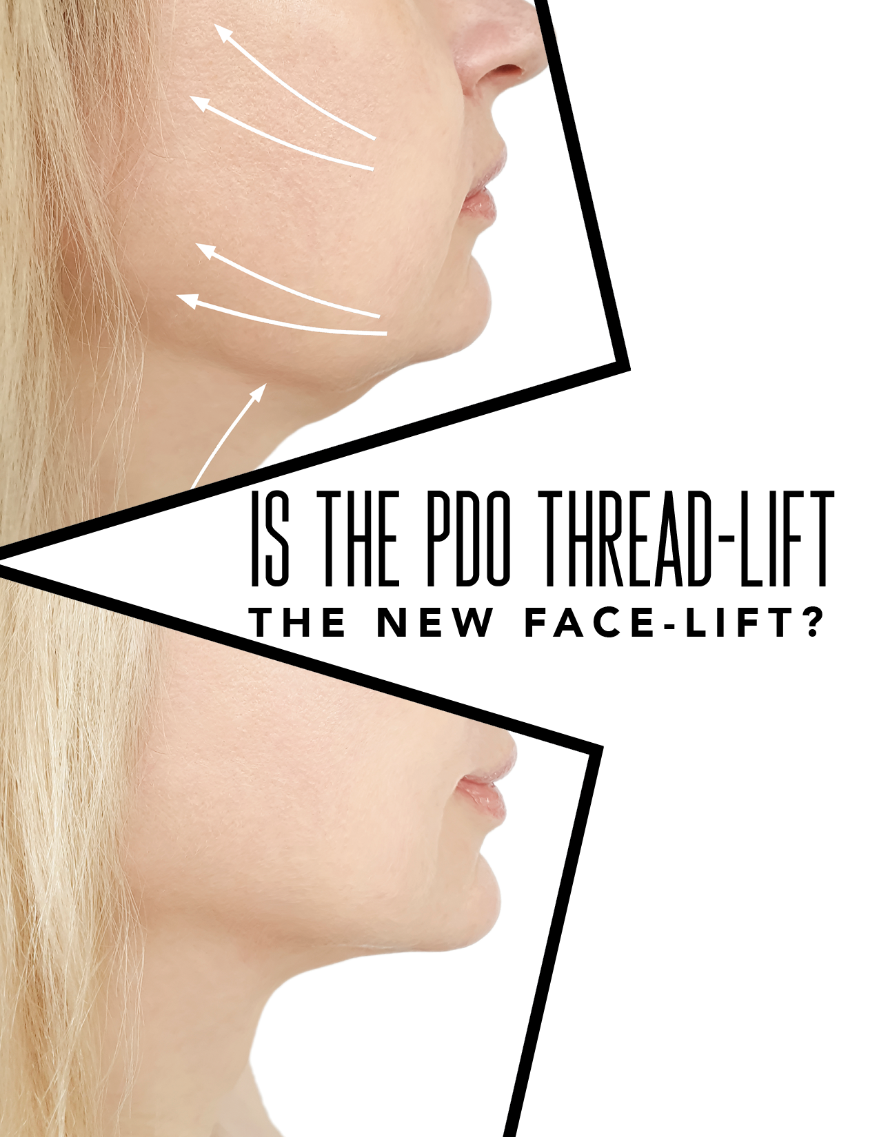 Is the PDO Thread Lift the New Face-Lift? Image