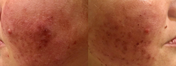 Acne Treatment #1683 Image
