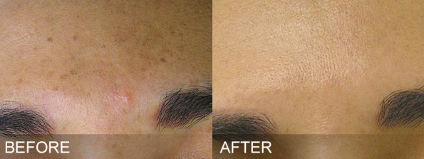 Age & Sun Spot Treatment #4877 Image