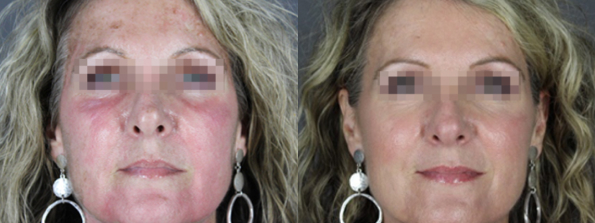Chemical Peel #9662 Image
