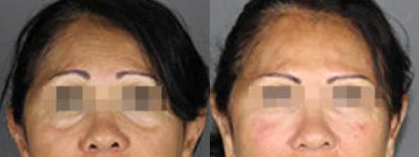 Injectables #6414 Image