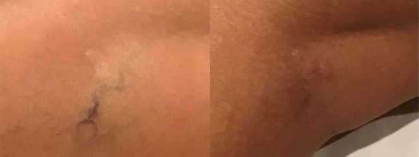 Spider Vein Treatment #7619 Image