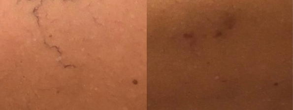 Spider Vein Treatment #7894 Image